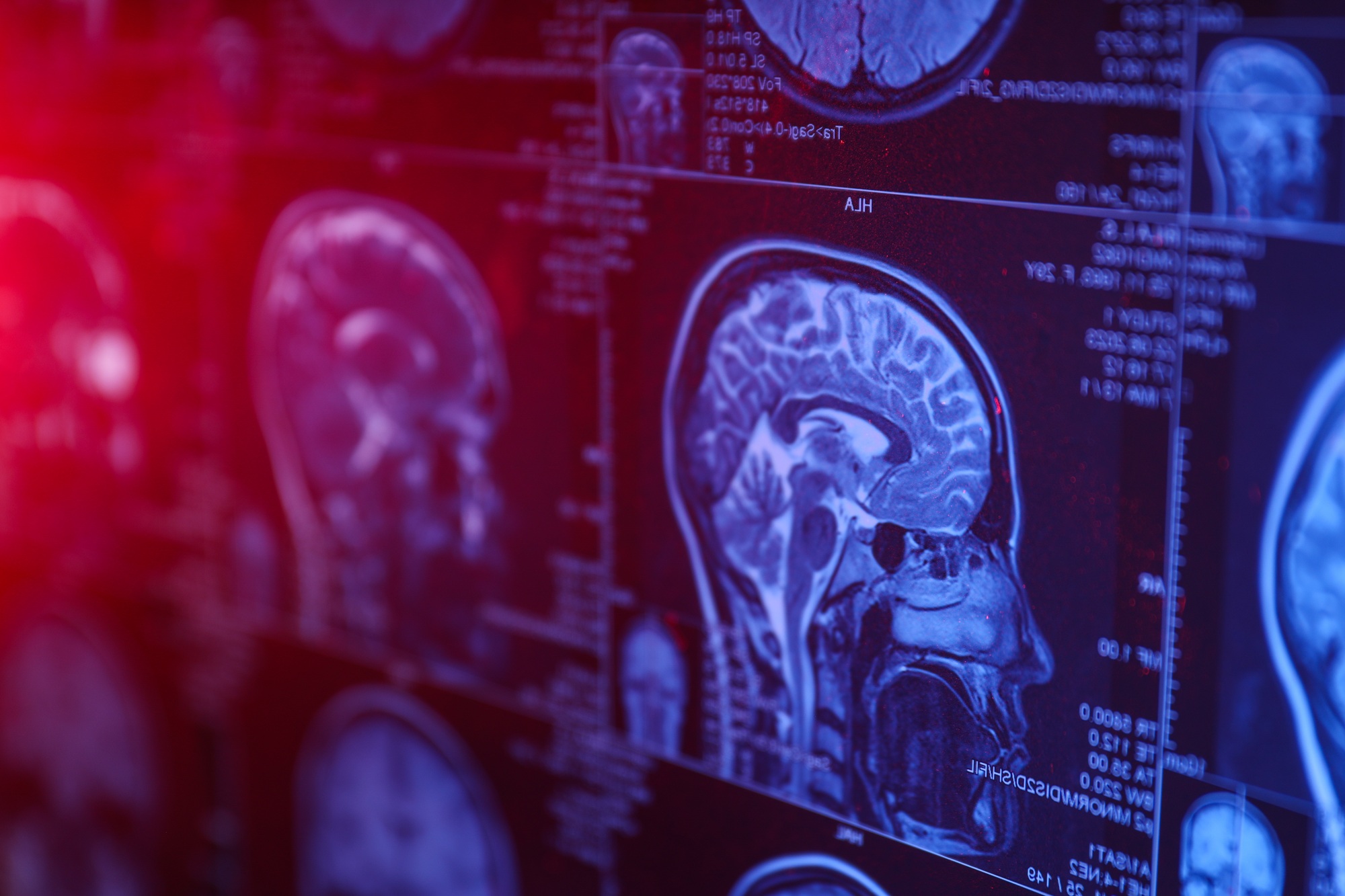 Proton therapy for brain tumors